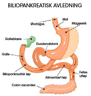 Biliopankreatisk avledning