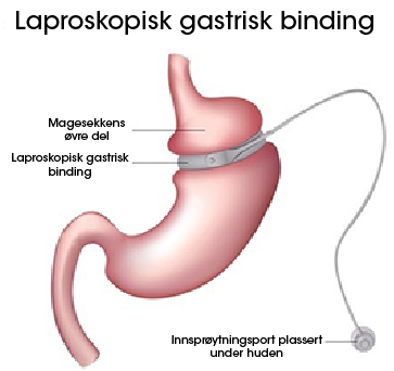 Gastrisk bånd