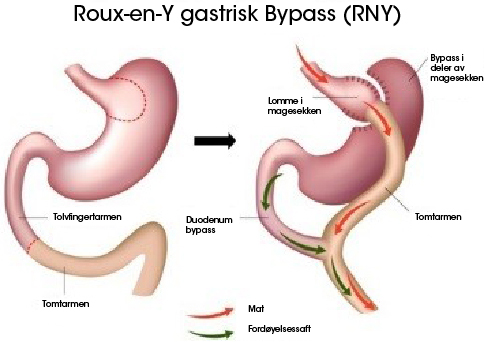 Gastrisk bypass opereasjon