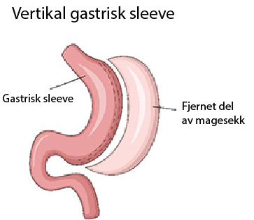 Gastrisk sleeve